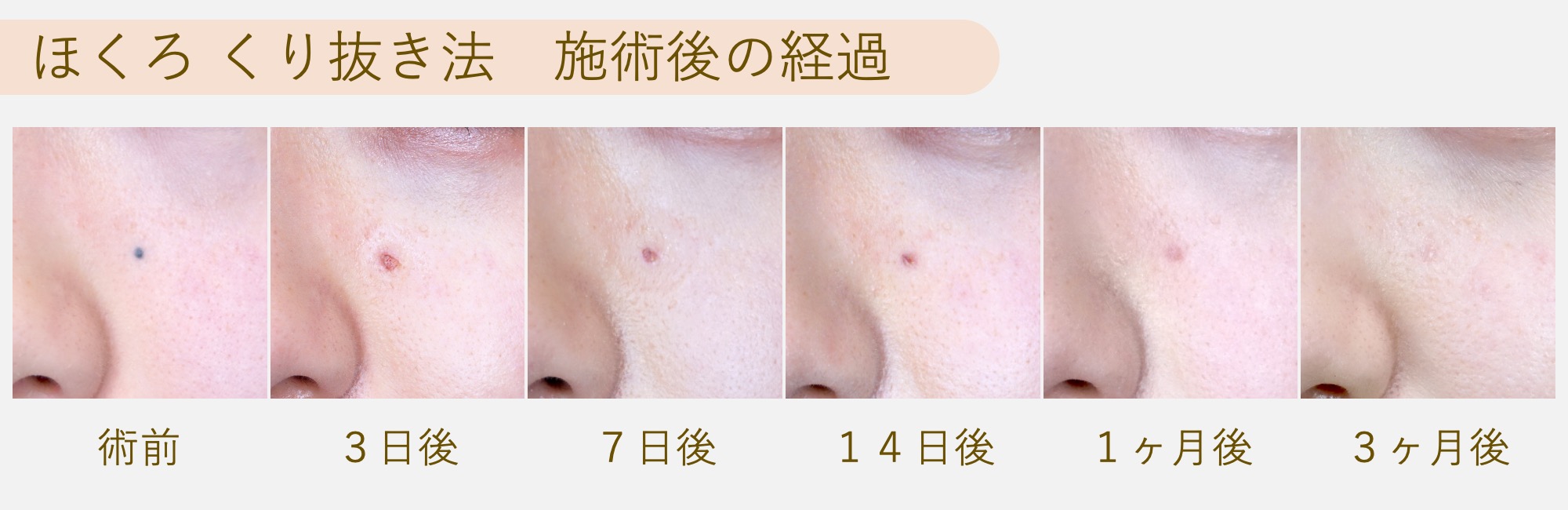 ほくろ取りのダウンタイム期間は？赤み・凹み経過と失敗回避の真相