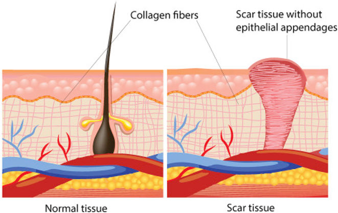 How Fast Does Scar Tissue Form