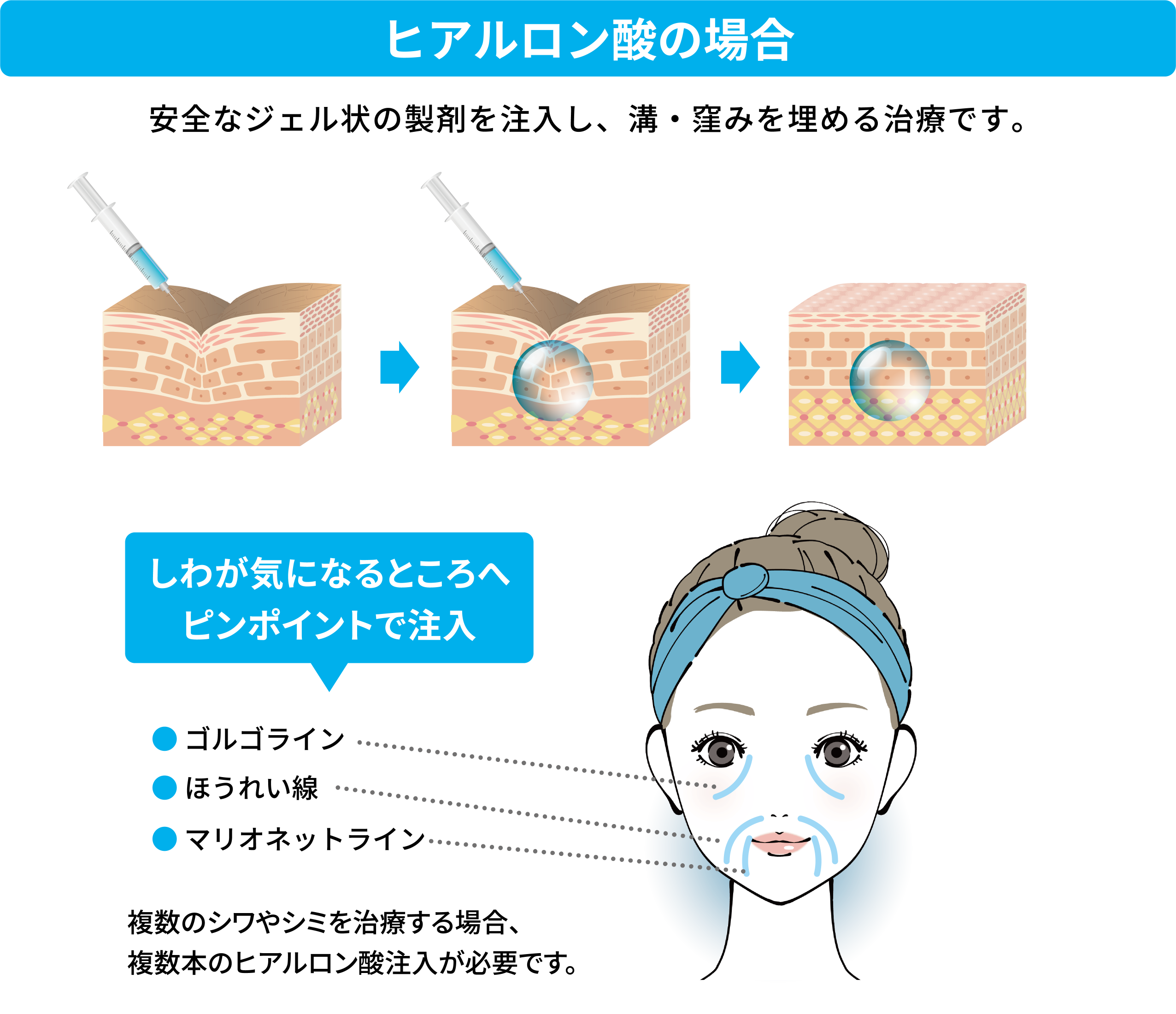 ためしてガッテン流「目の下のたるみ」改善法と2026年最新セルフケア