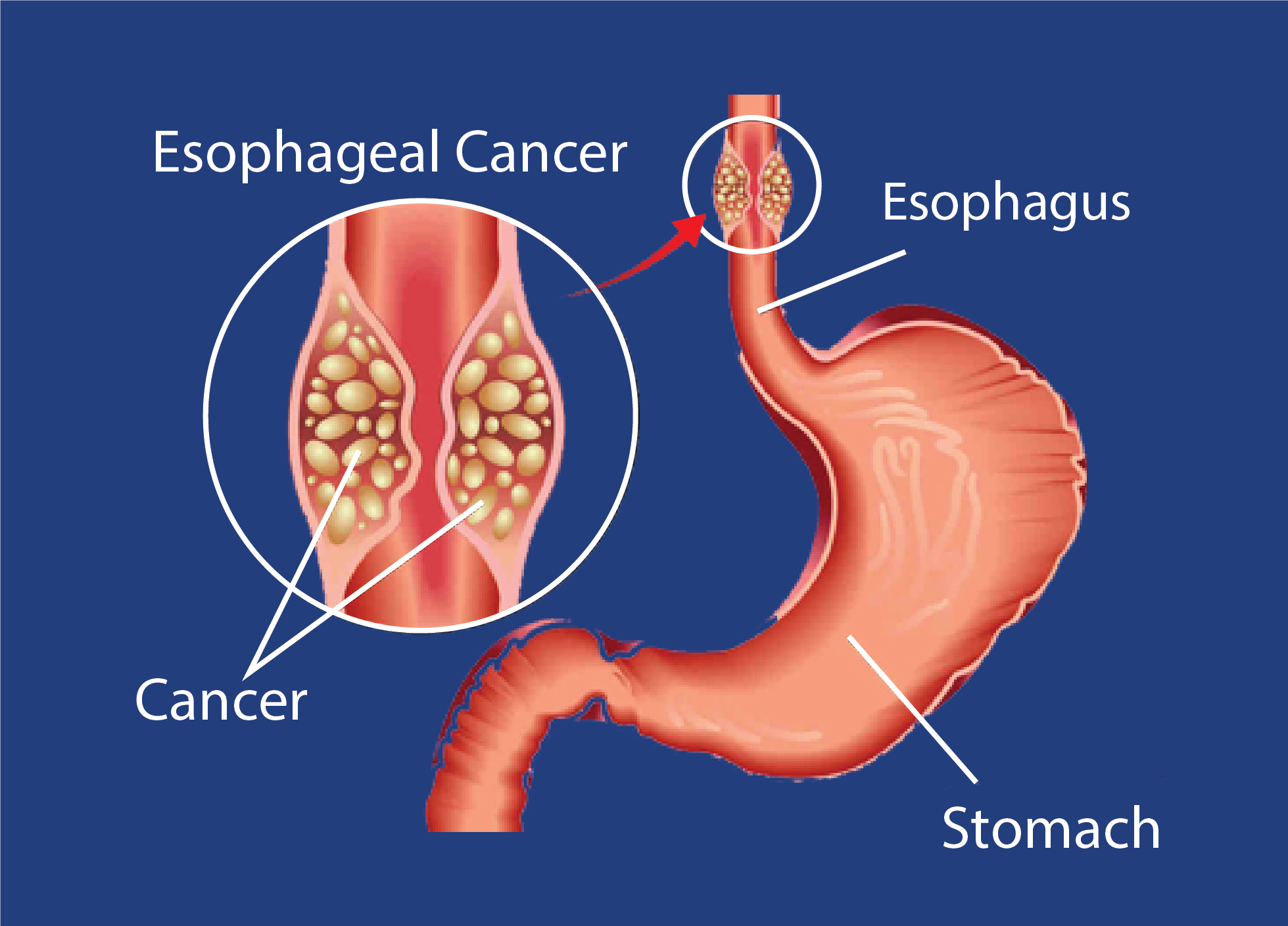 Is Esophagitis Cancer? What Kim Kardashian’s Diagnosis Does—and Does Not—Mean