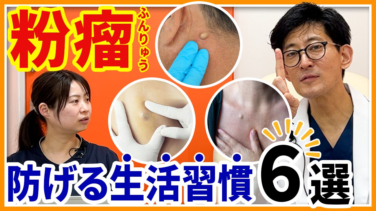 なぜ何度も再発？粉瘤ができやすい人の体質と最新治療法を徹底検証