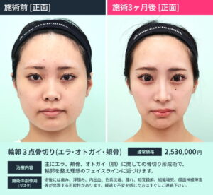 2026年、美の基準が変わる。「頬骨が出ている」ことが最強のチャームポイントとされる理由と、時代を牽引するアイコンたち