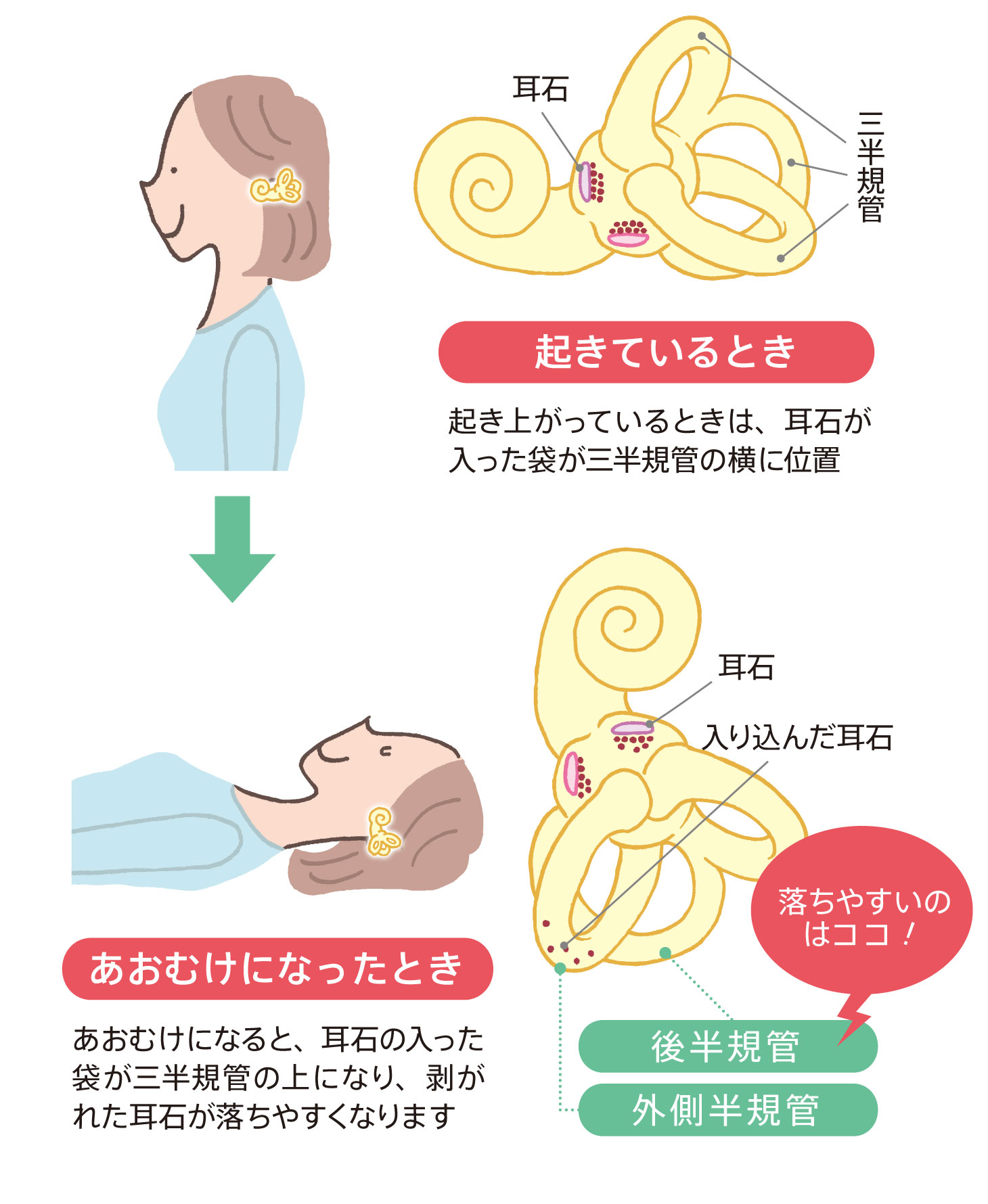 朝のめまいはなぜ？耳石がはがれる原因と知っておくべき治し方