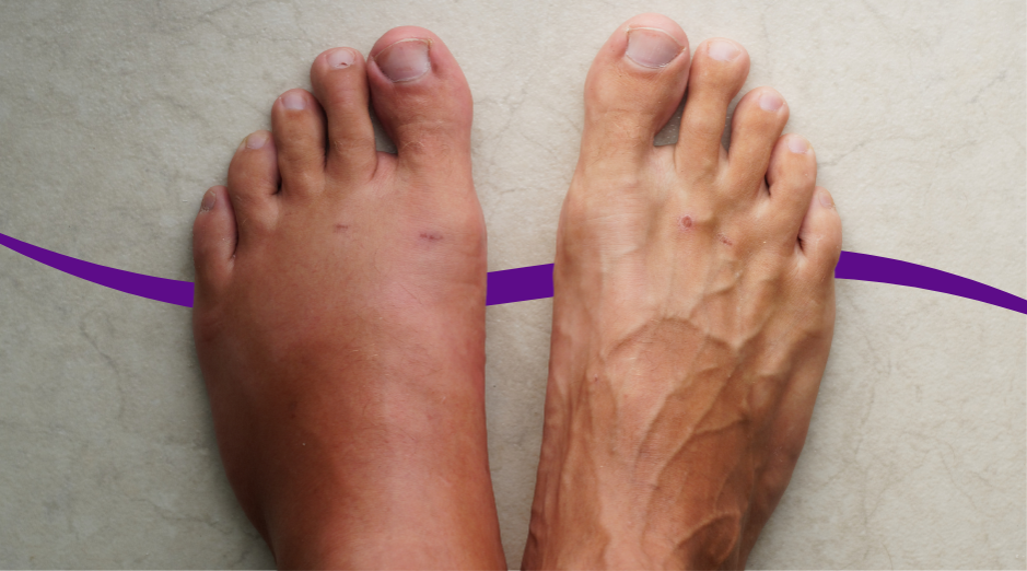 Swelling of Feet in Hot Weather