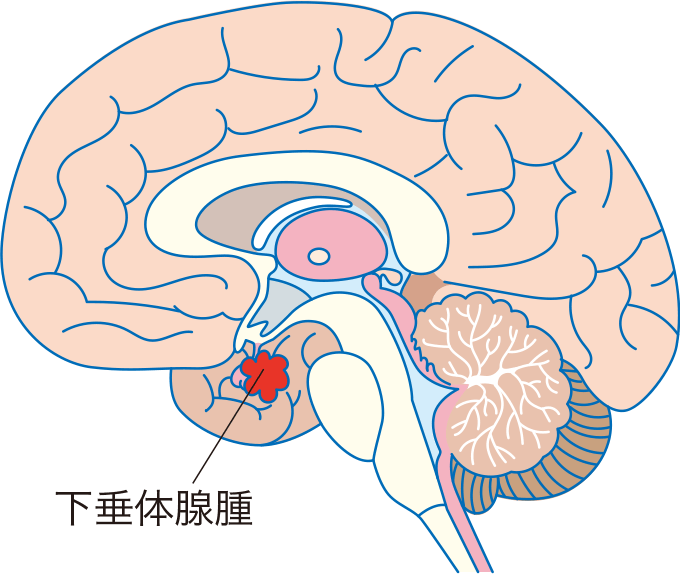 ガンバレルーヤよしこ下垂体腺腫の全貌｜鼻の異変から奇跡の復帰