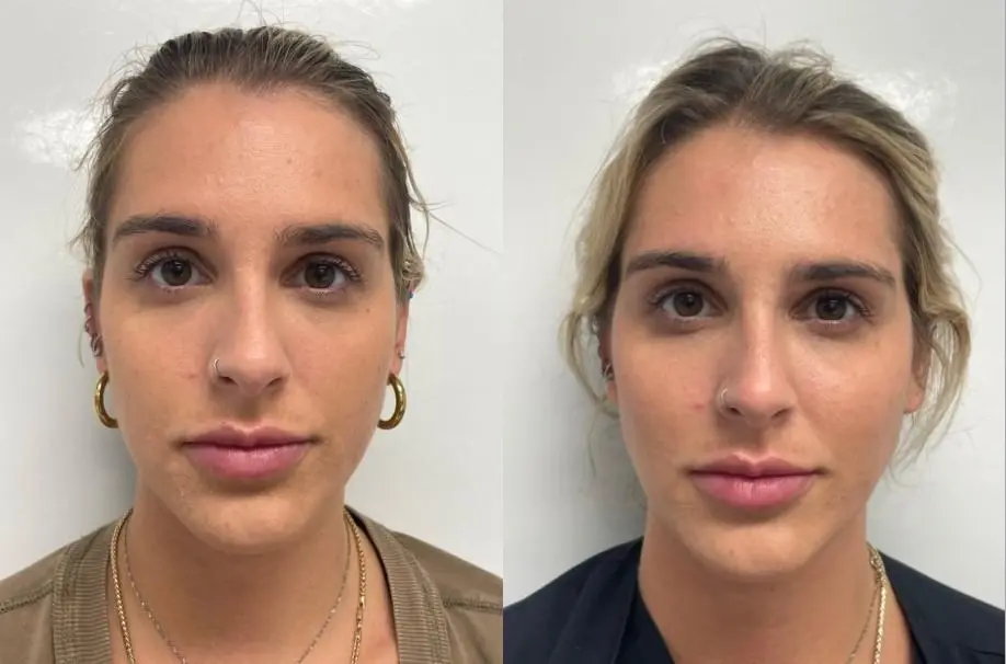 Why I Stopped Using Fillers After 2 Year's Forum