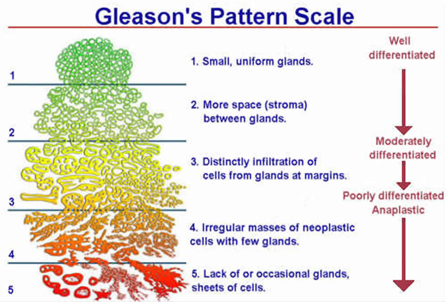 Prostate Gleason Score 6
