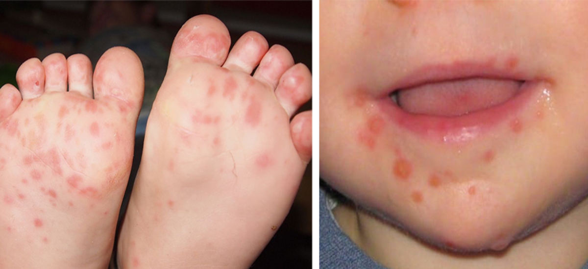 Can You Get Foot and Mouth Disease Twice