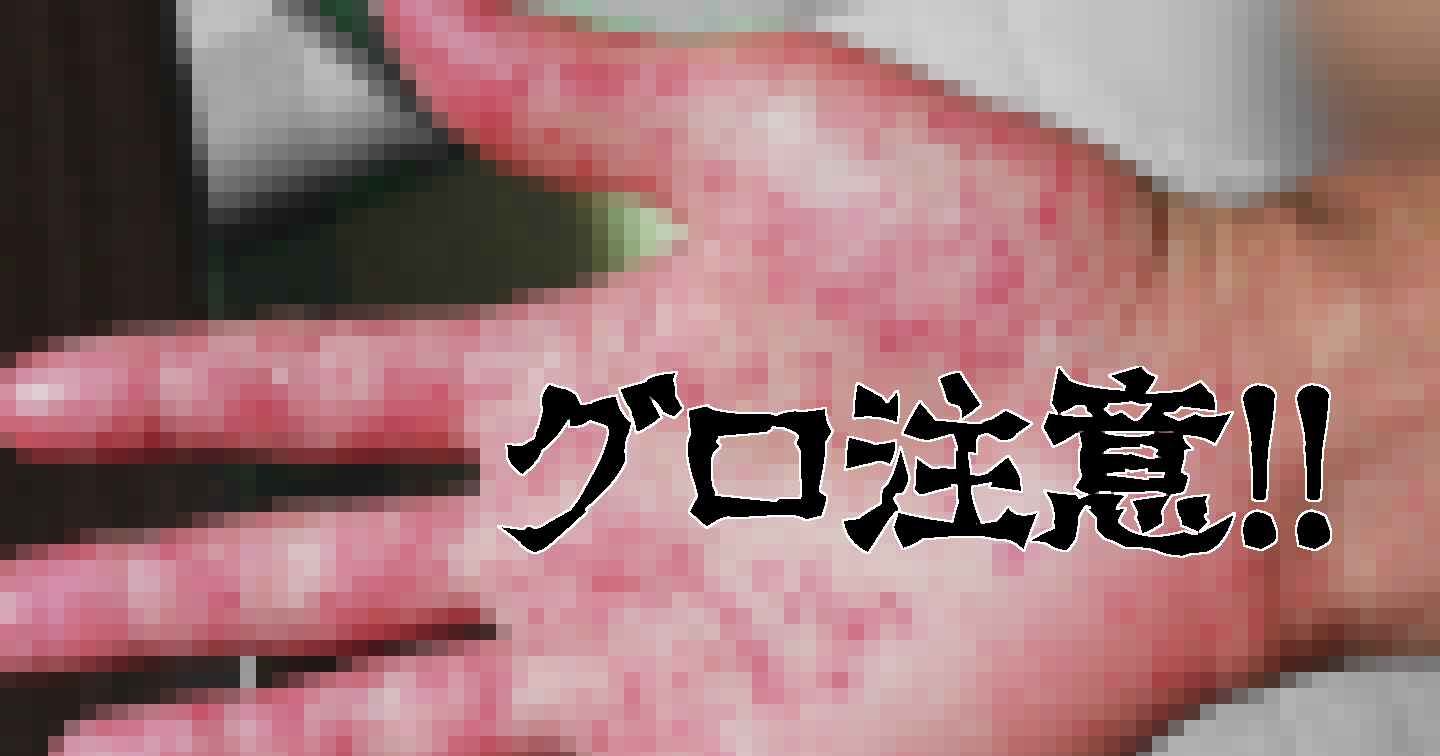 大人の手足口病写真と初期症状｜激痛や爪が剥がれる後遺症を解説