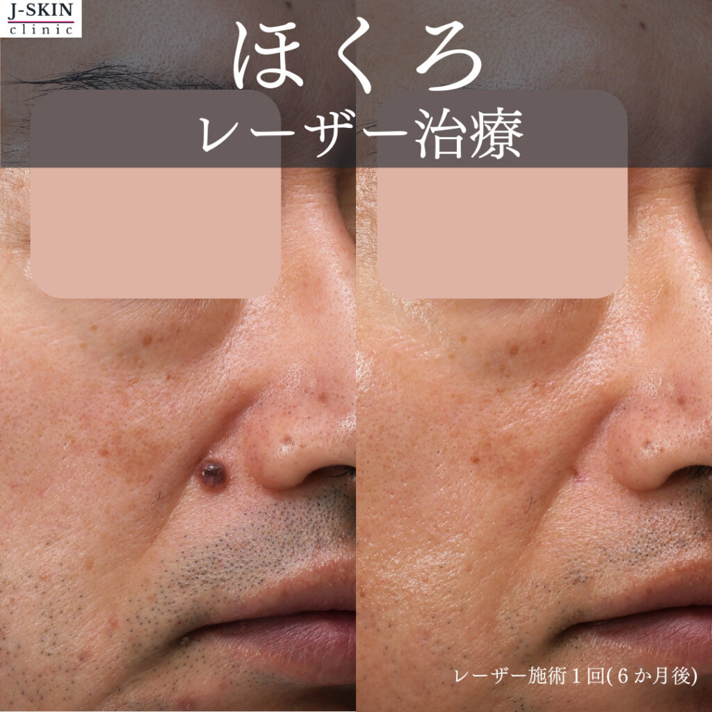 ほくろが多い人の決定的な原因とは？メラノーマ見分け方と対策