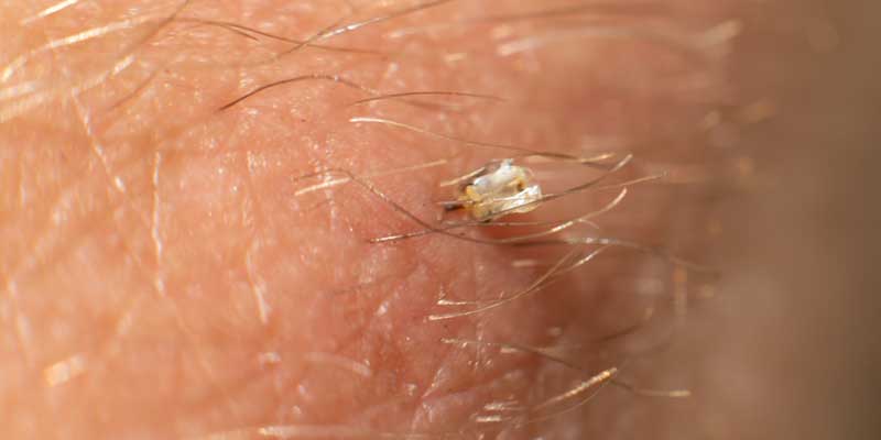Bee Stinger Stuck Under Skin