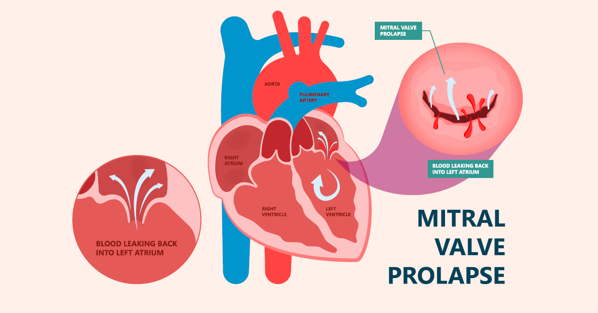 Symptoms of Mitral Valve Prolapse