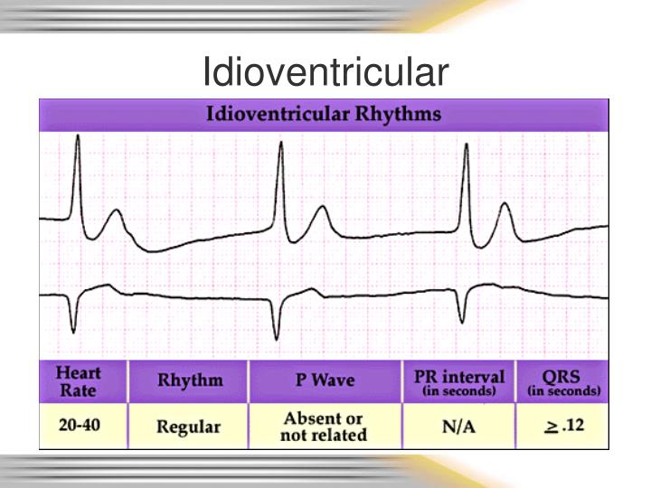What Does Idioventricular Rhythm Look Like