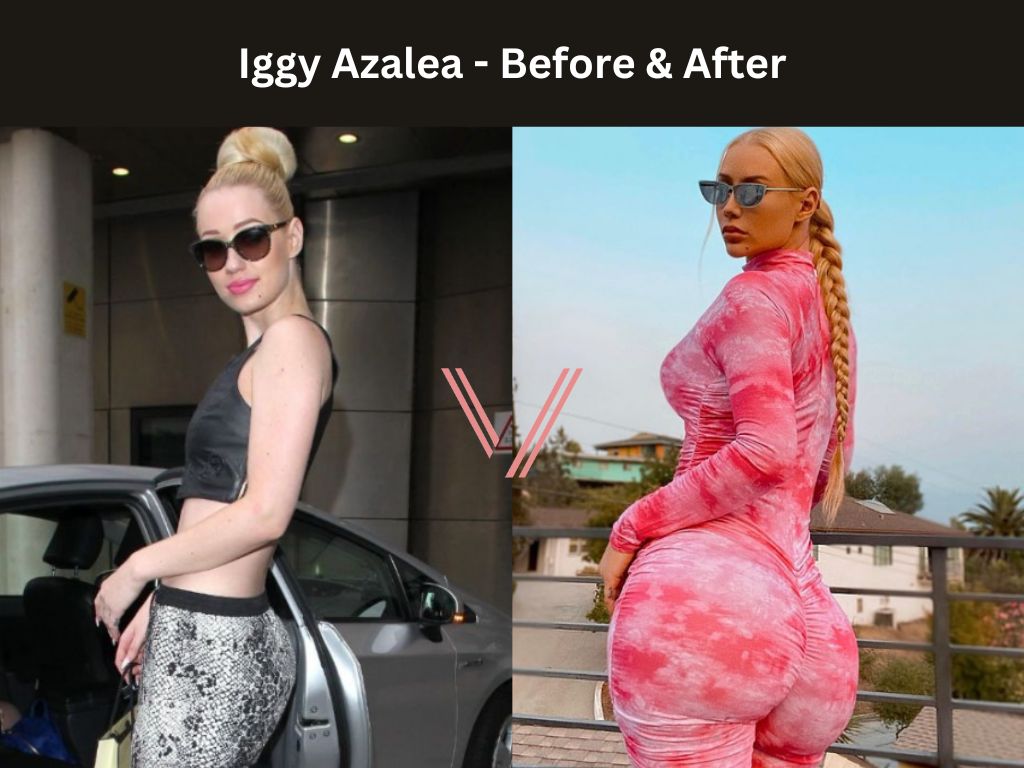 Does Iggy Azalea Have a Bbl