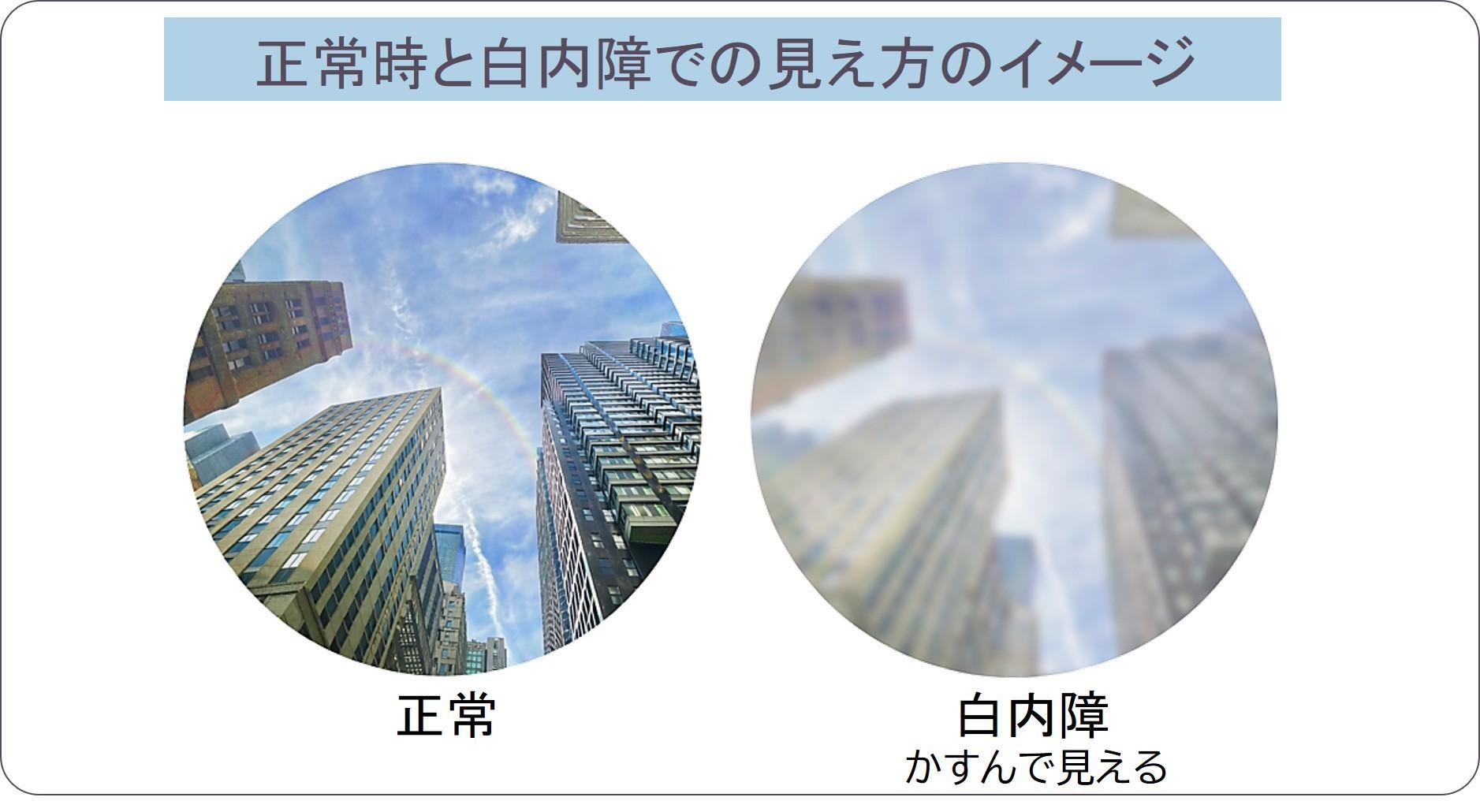 緑内障と白内障の違いとは？失明リスクと最新治療の見分け方を徹底解説