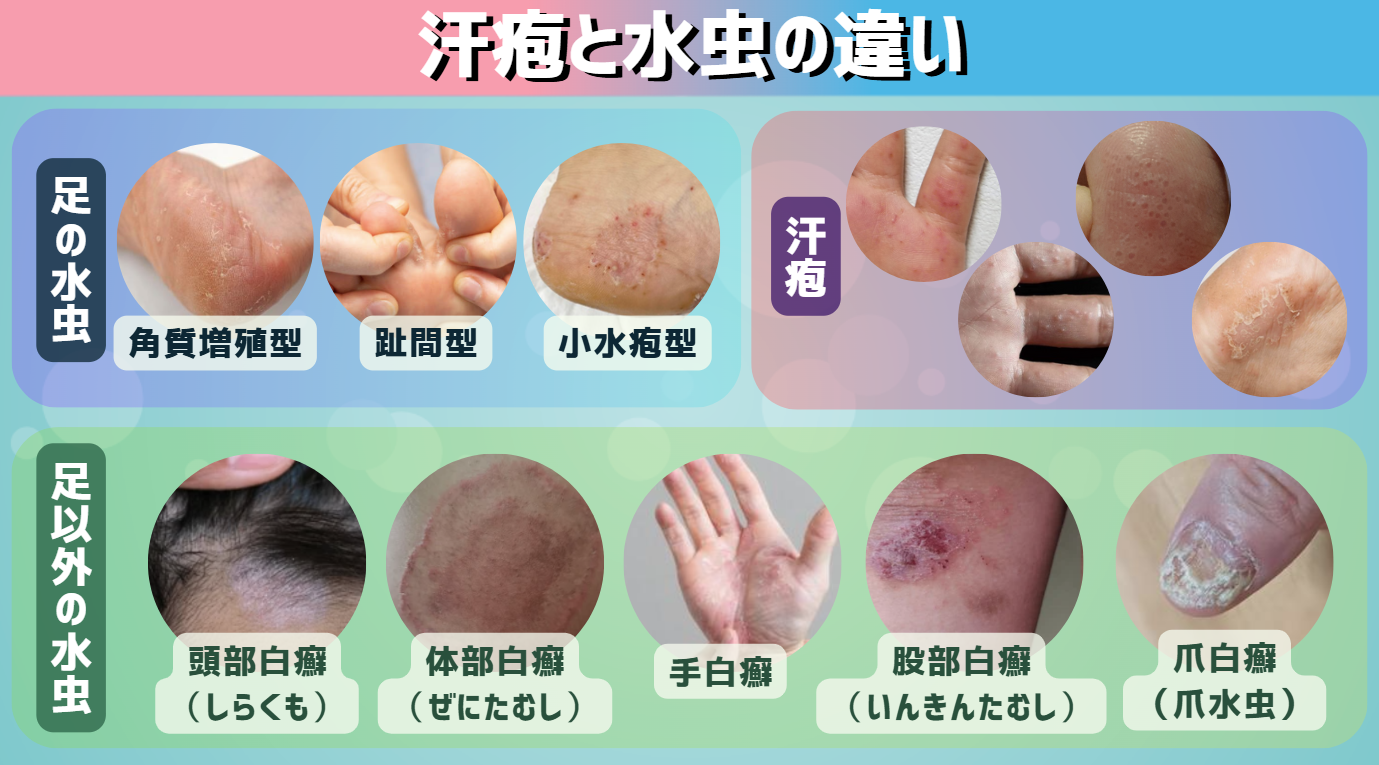 足の痒みは汗疱か水虫か？見分け方と市販薬の落とし穴【2026最新】