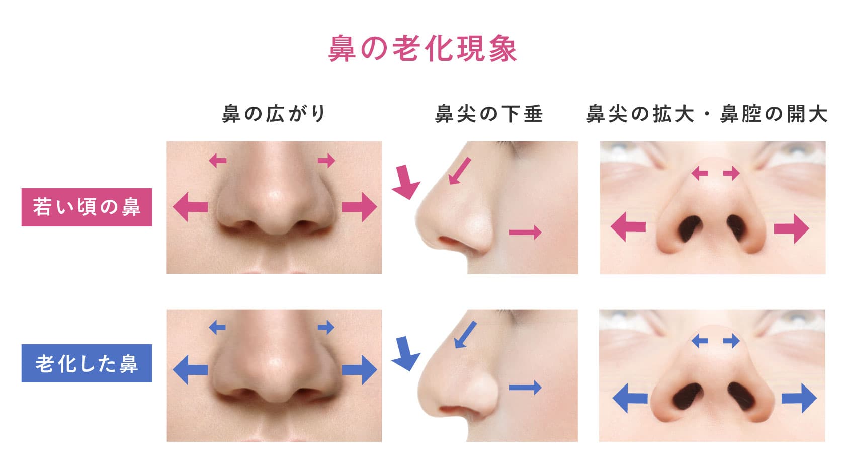 「昔より鼻が大きくなった？」鼻の肥大化が進む原因と最新の改善法
