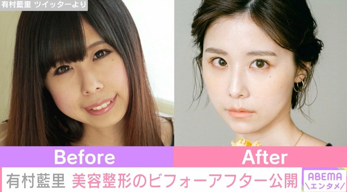 有村藍里が語る整形の真相｜骨切り手術の全貌と劇的な変化の軌跡