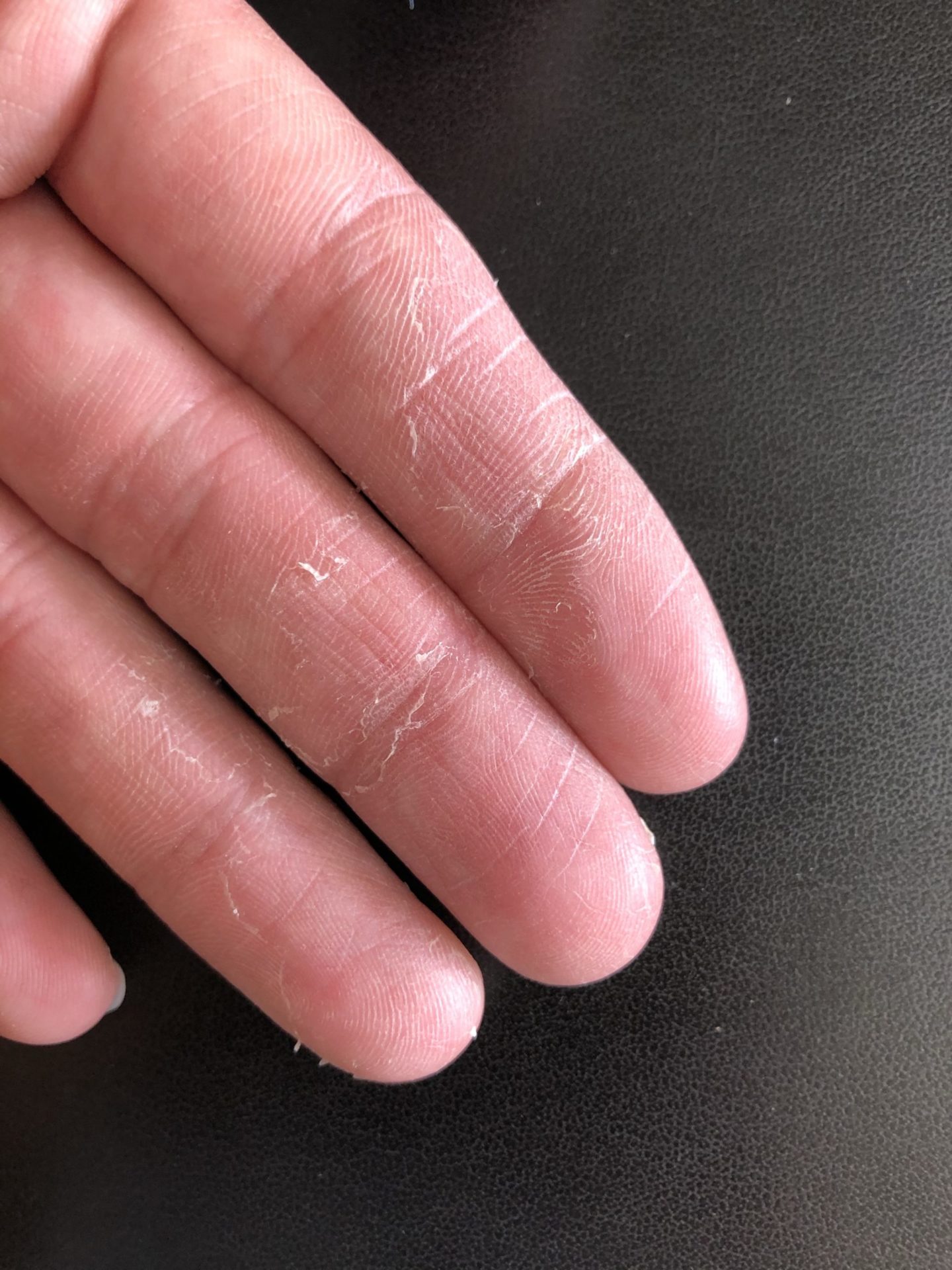 指の皮がむける原因と病気のサイン！痛くない理由と最新の治し方