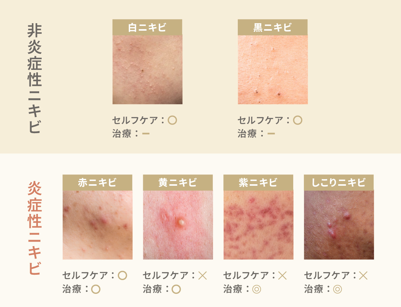 赤いニキビ跡が消えない原因とは？炎症後紅斑の治し方と最新皮膚科治療