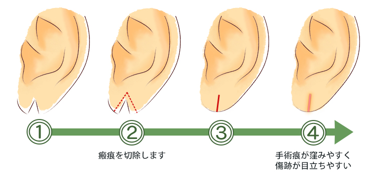 耳のピアスしこりは放置厳禁？痛くない理由と最新の正しい治し方