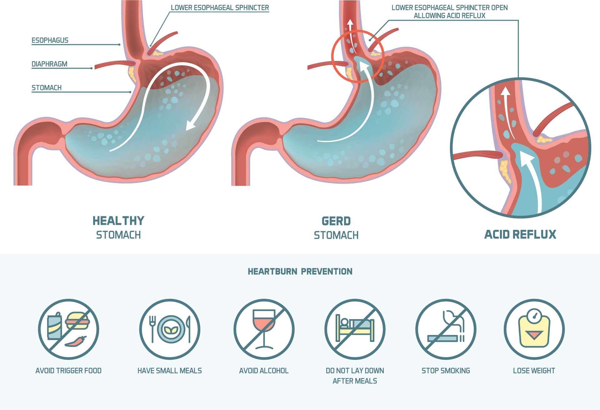 Does Soda Cause Acid Reflux