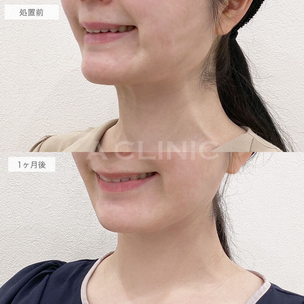 広頚筋ボトックスの真実と失敗リスク｜首の縦ジワ解消と費用相場
