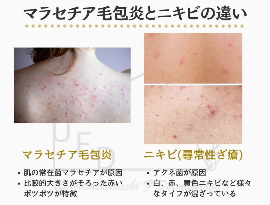 治らない背中や胸のブツブツ！ニキビとマラセチア毛包炎の見分け方