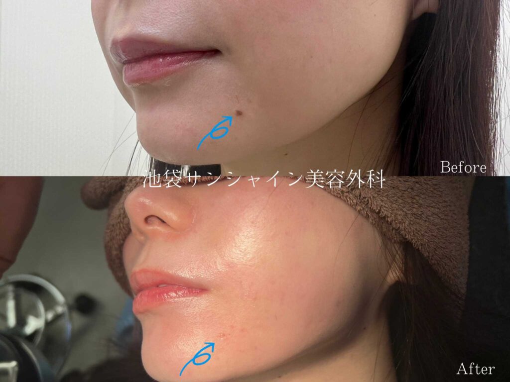 ほくろに毛が生える理由と抜くリスク｜皮膚科医が教える正しい対処法