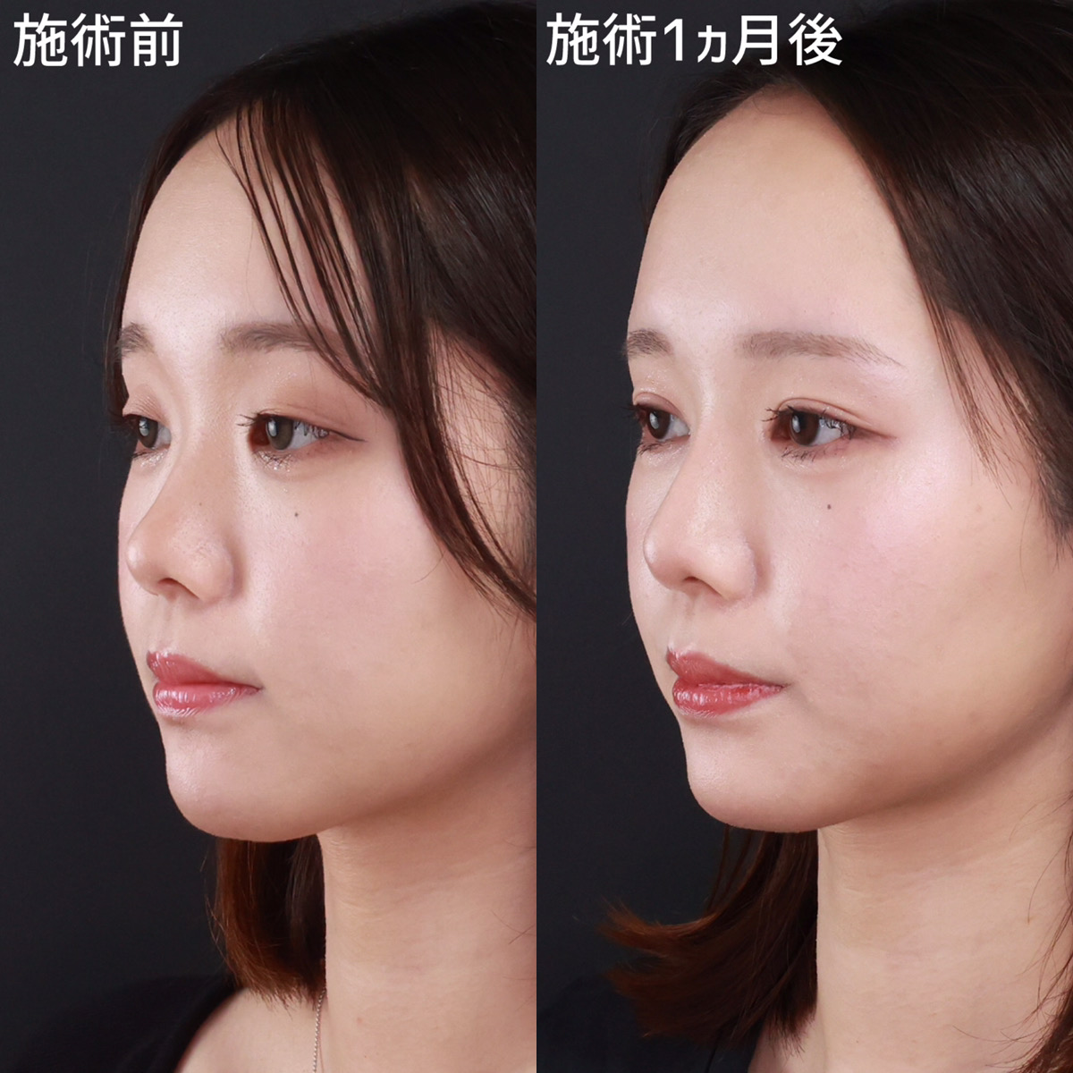 あの人も不自然？整形バレバレ芸能人の激変理由と最新真相を徹底解明