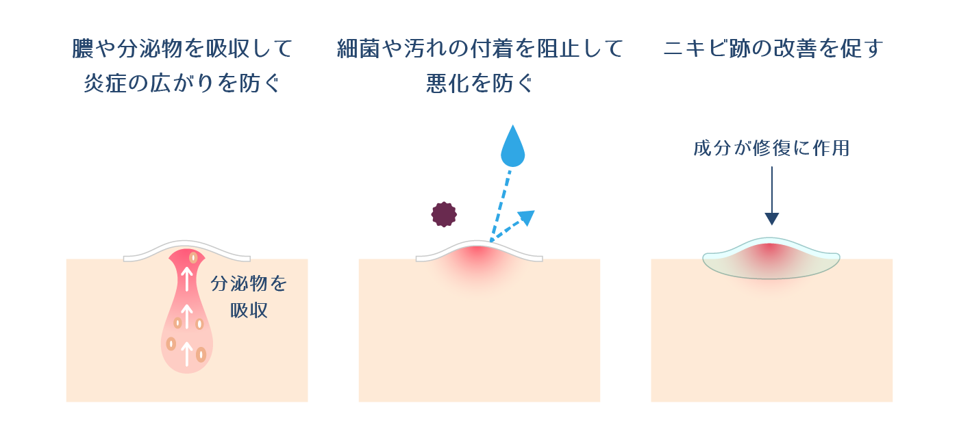ニキビパッチの正しい使い方と貼るタイミング完全解説【2026年最新】