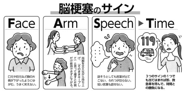 「ただの熱中症」は危険！夏の脱水が招く脳梗塞の見分け方と救急基準