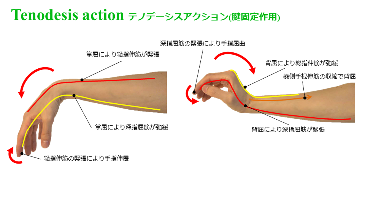 テノデーシスアクションの仕組み解剖｜C6頸損とリハビリの全貌