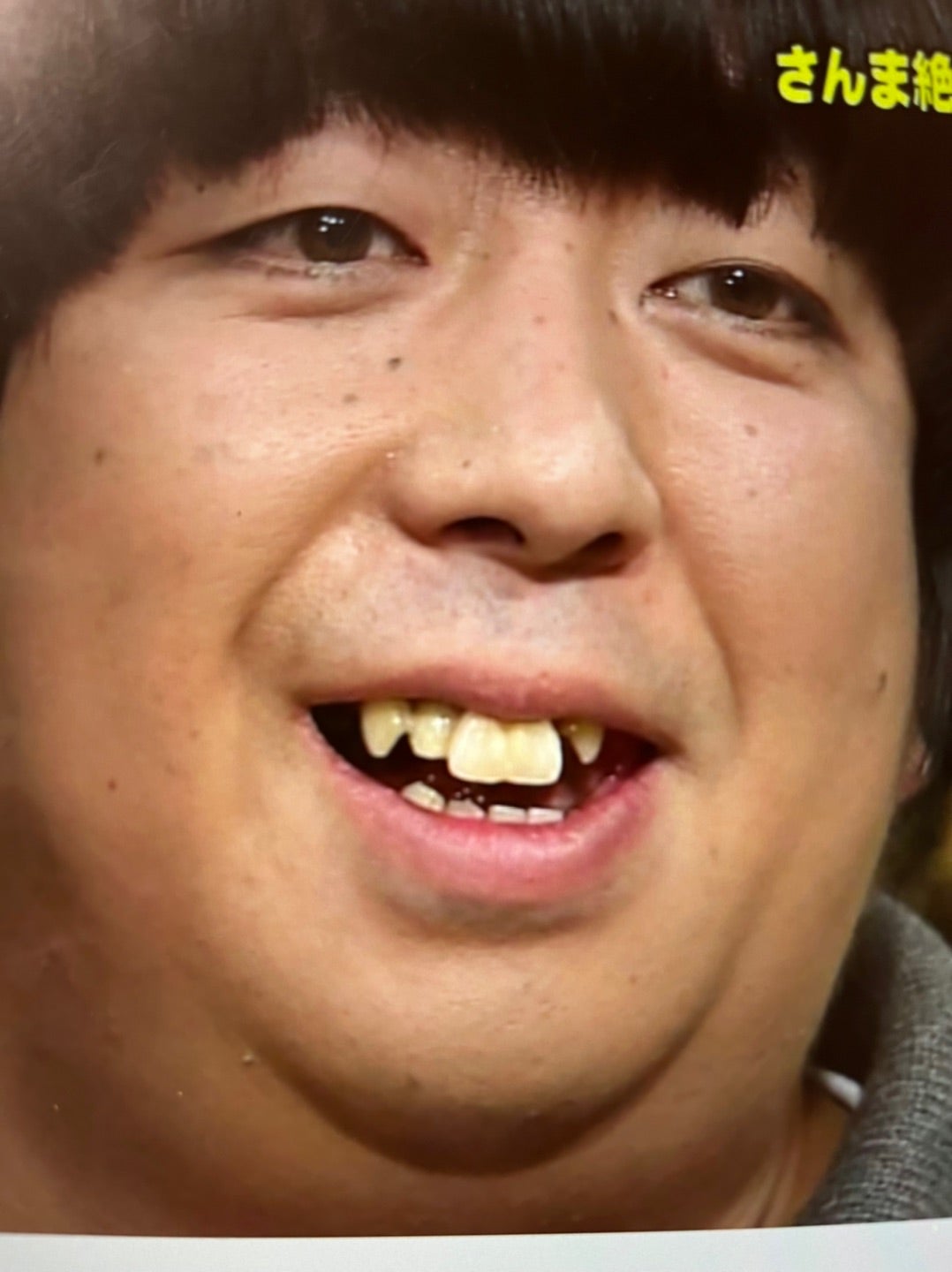 バナナマン日村の歯はなぜ激変？総額500万インプラントの全貌