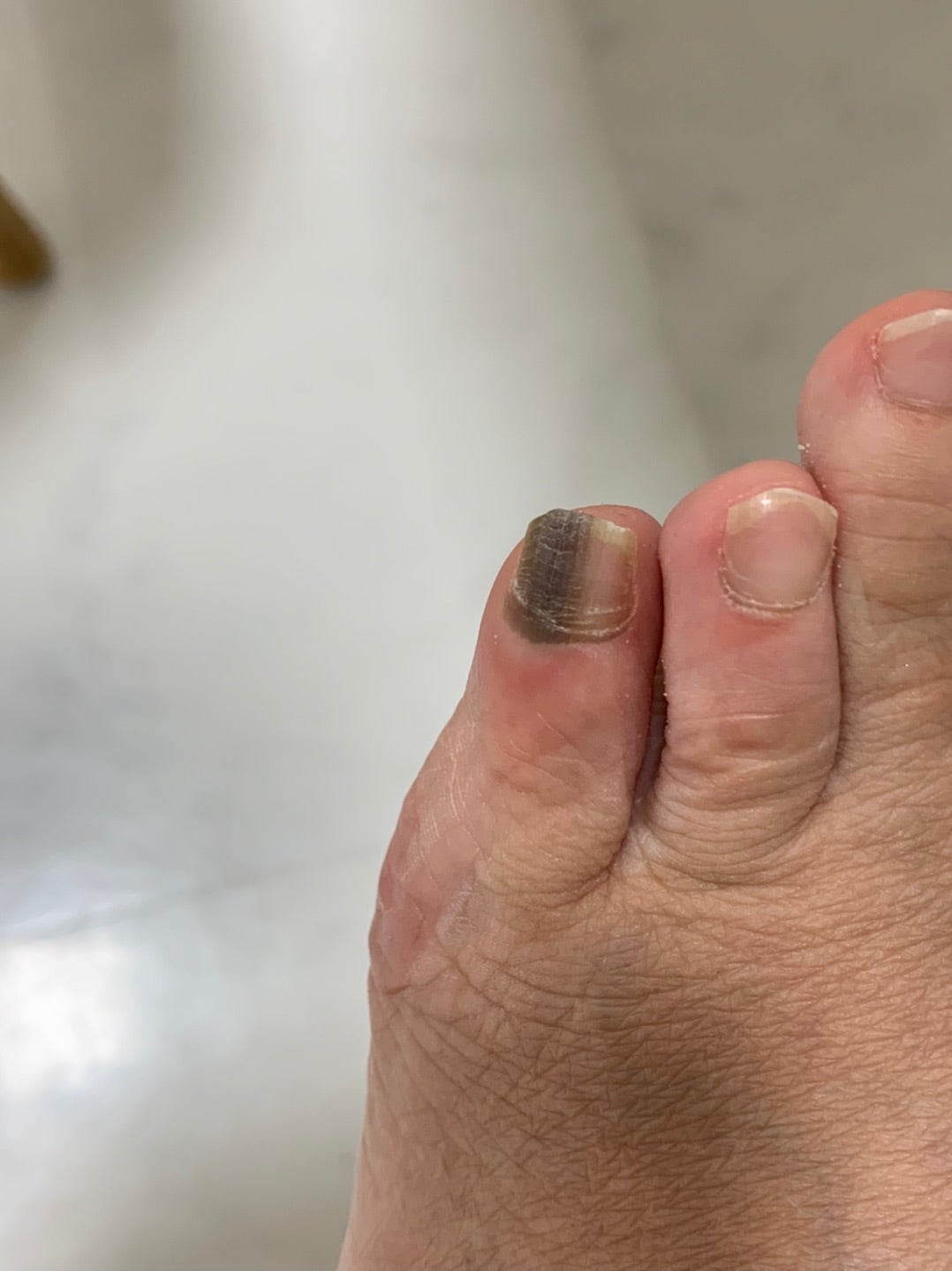 爪が黒い画像と病気の真相｜血豆かメラノーマか見分ける決定的基準