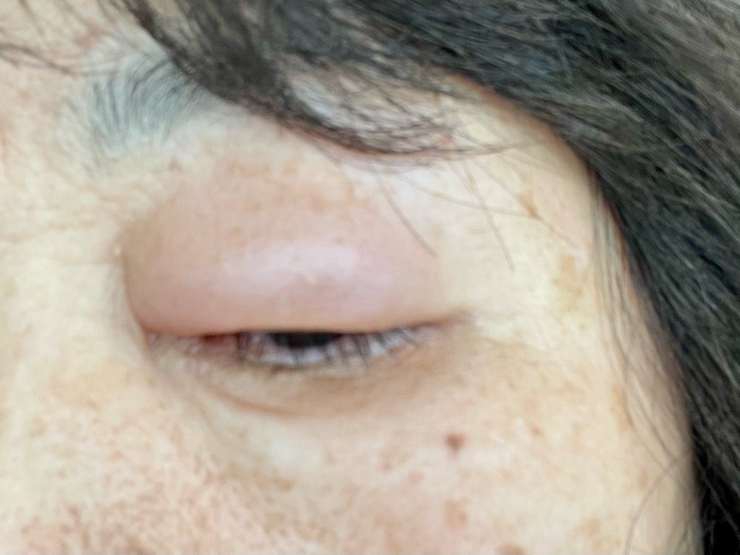 目の周りの蕁麻疹やまぶたの腫れ！原因・クインケ浮腫と受診の目安