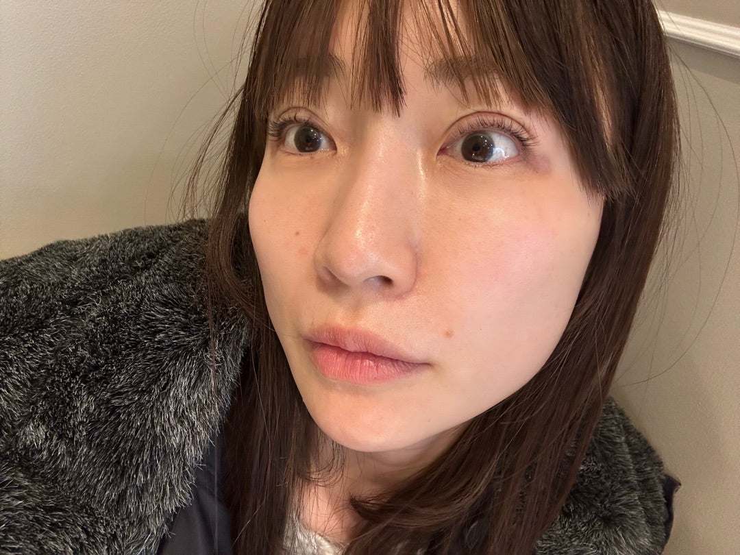 あいのり桃の二重整形！理由や費用・ビフォーアフターと現在の経過を解剖