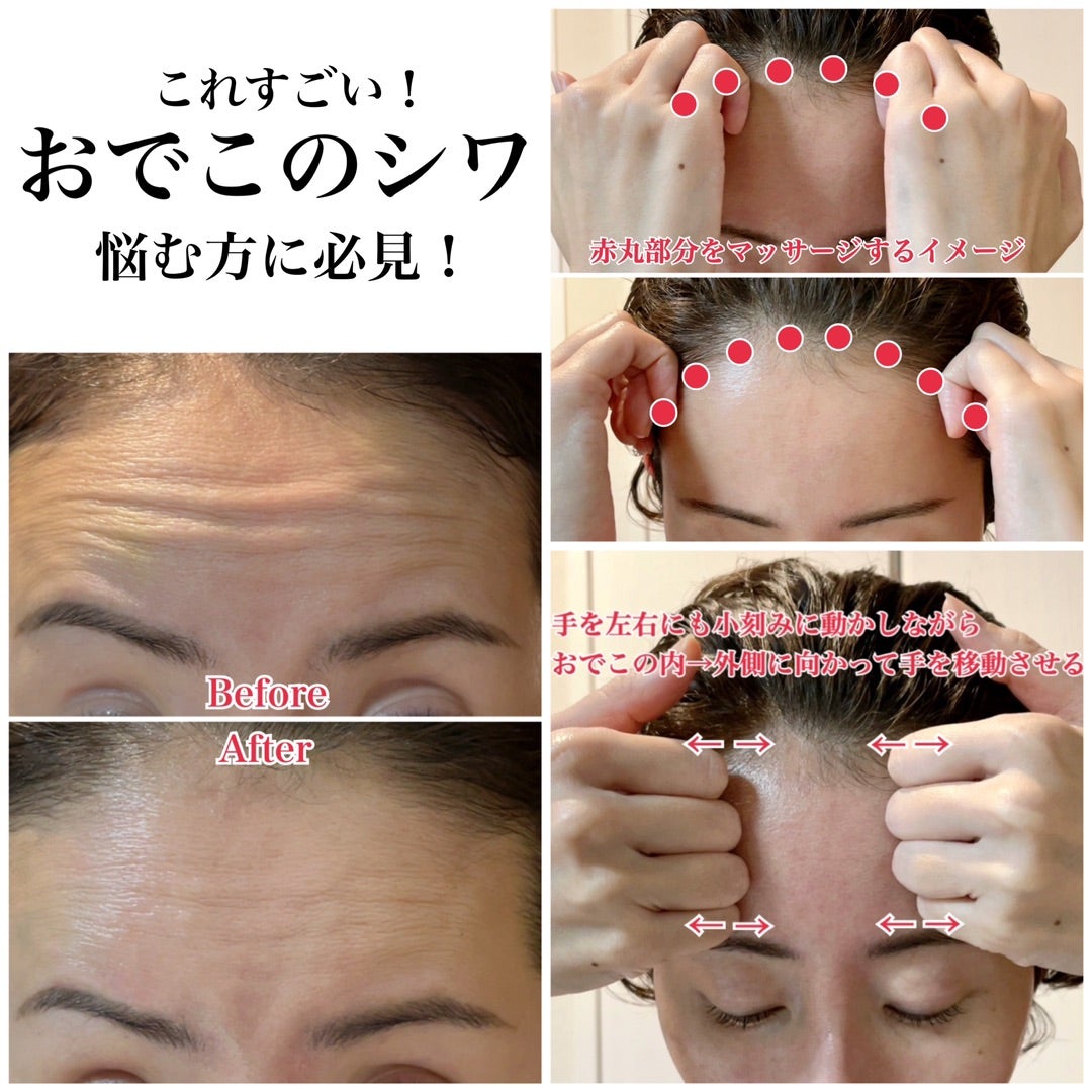 【2026年最新取材】額の刻みジワに「ボトックスなし」で挑む：表情を固めず若返る最新・美容医療の最前線