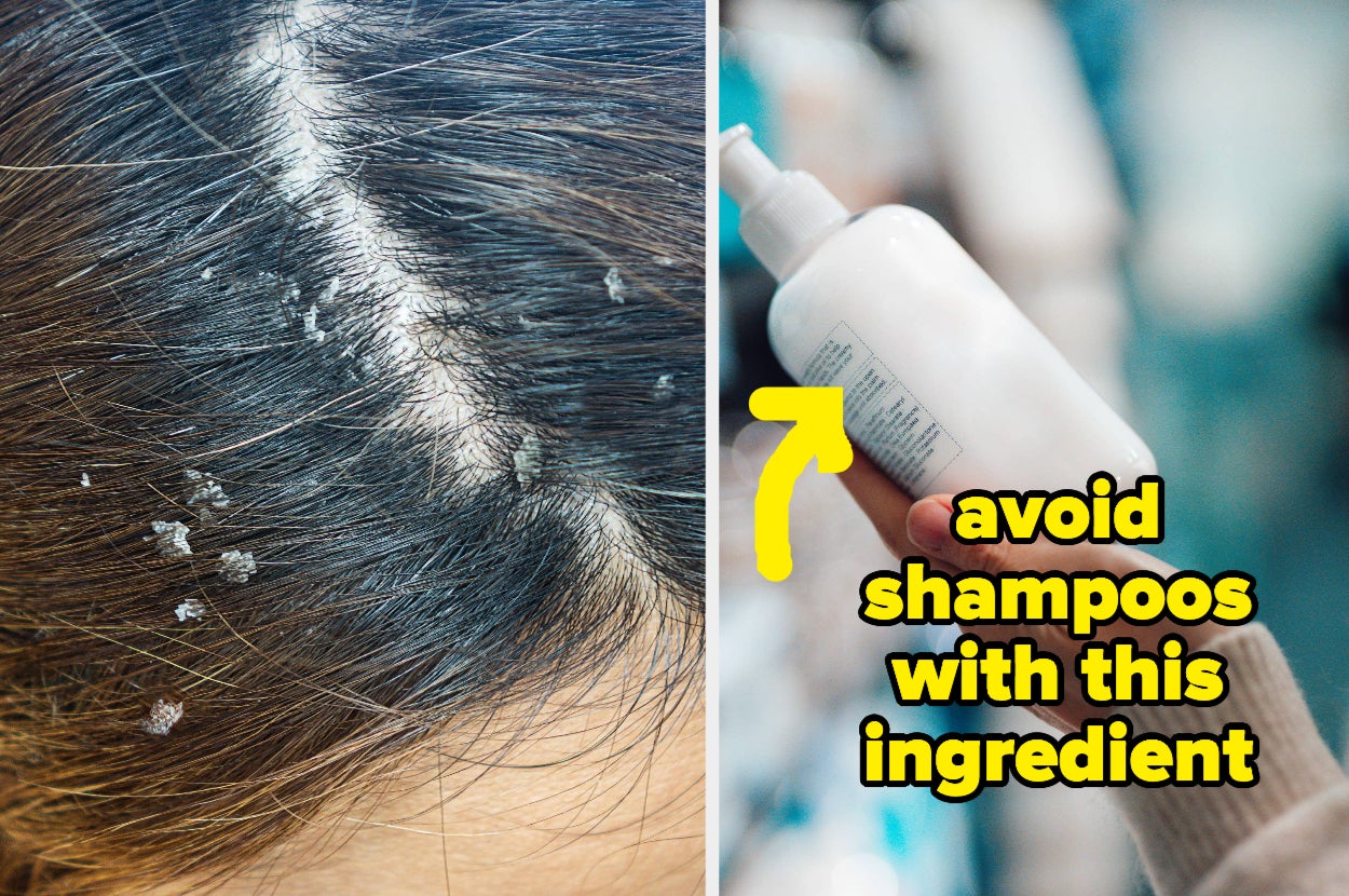 How to Deal with a Dry Scalp