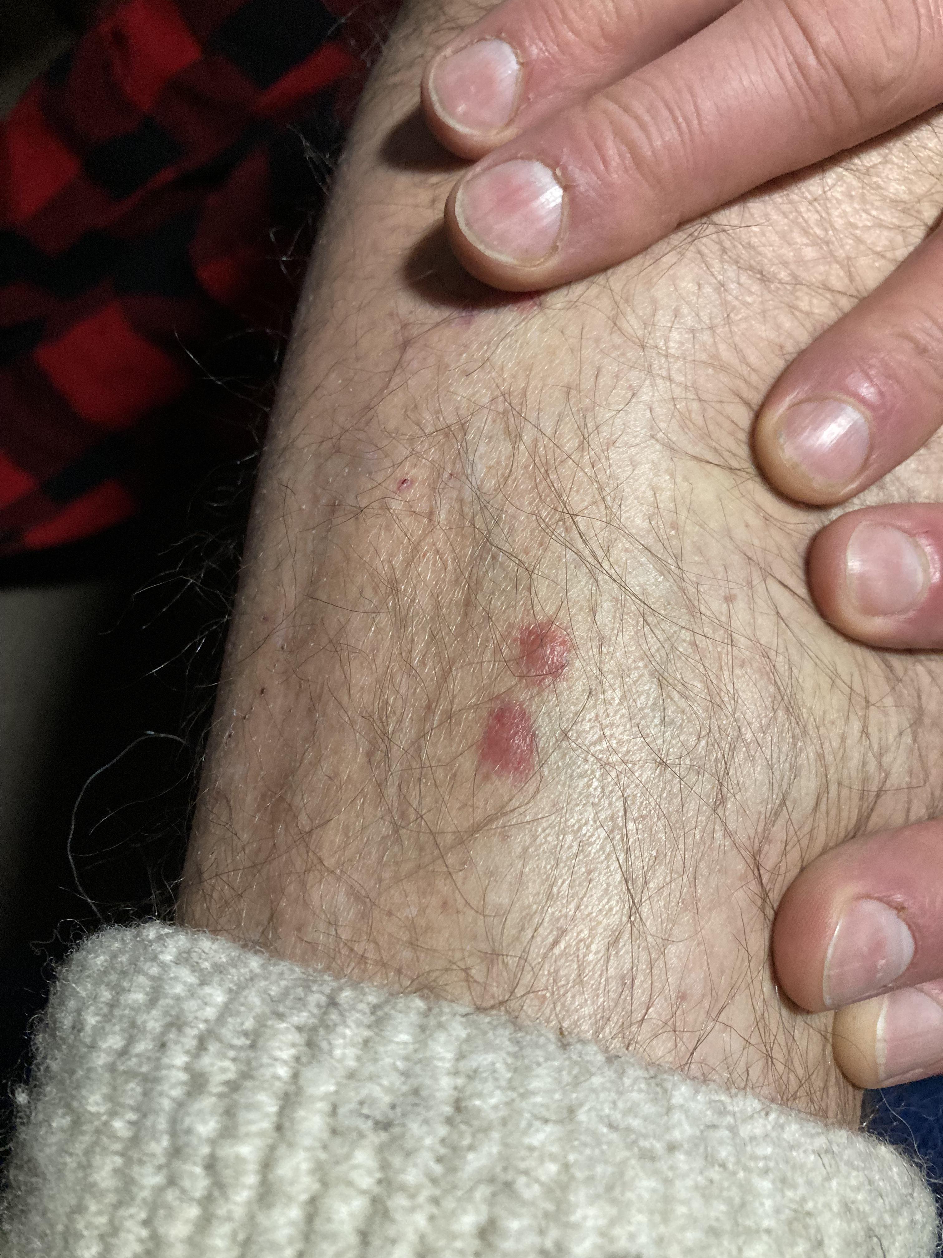 その赤い腫れはダニの噛み跡？見分け方の特徴と長引く痒みの治し方