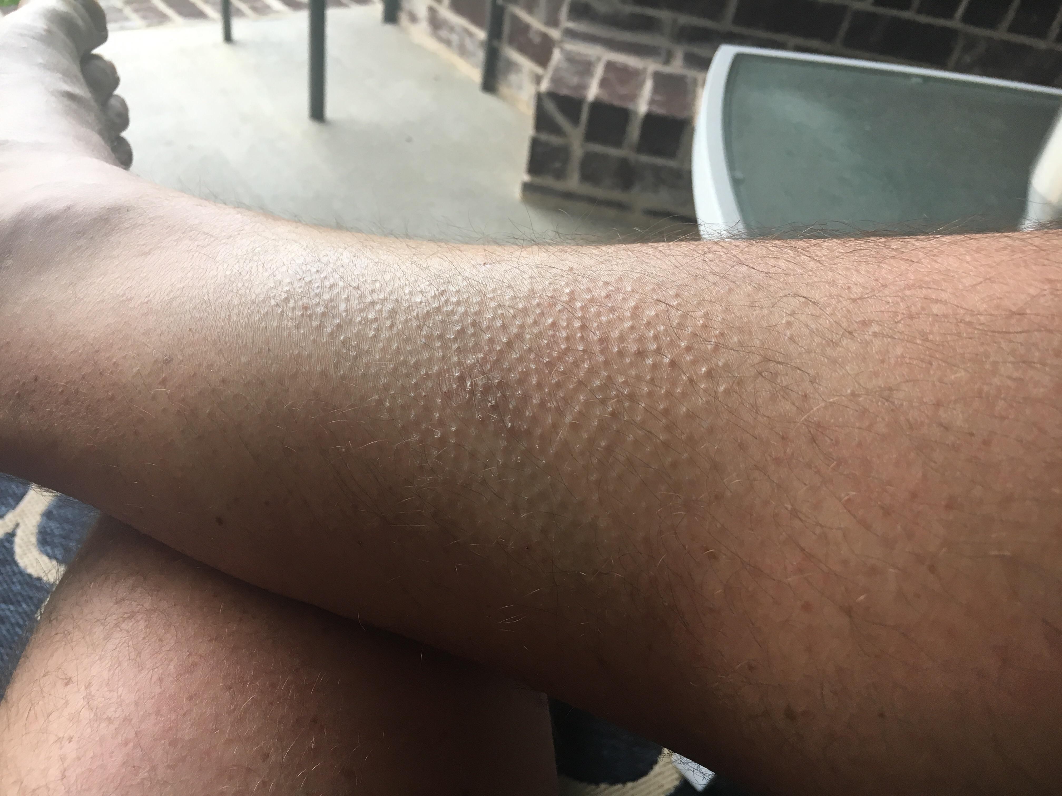 Chicken Skin and Itchy