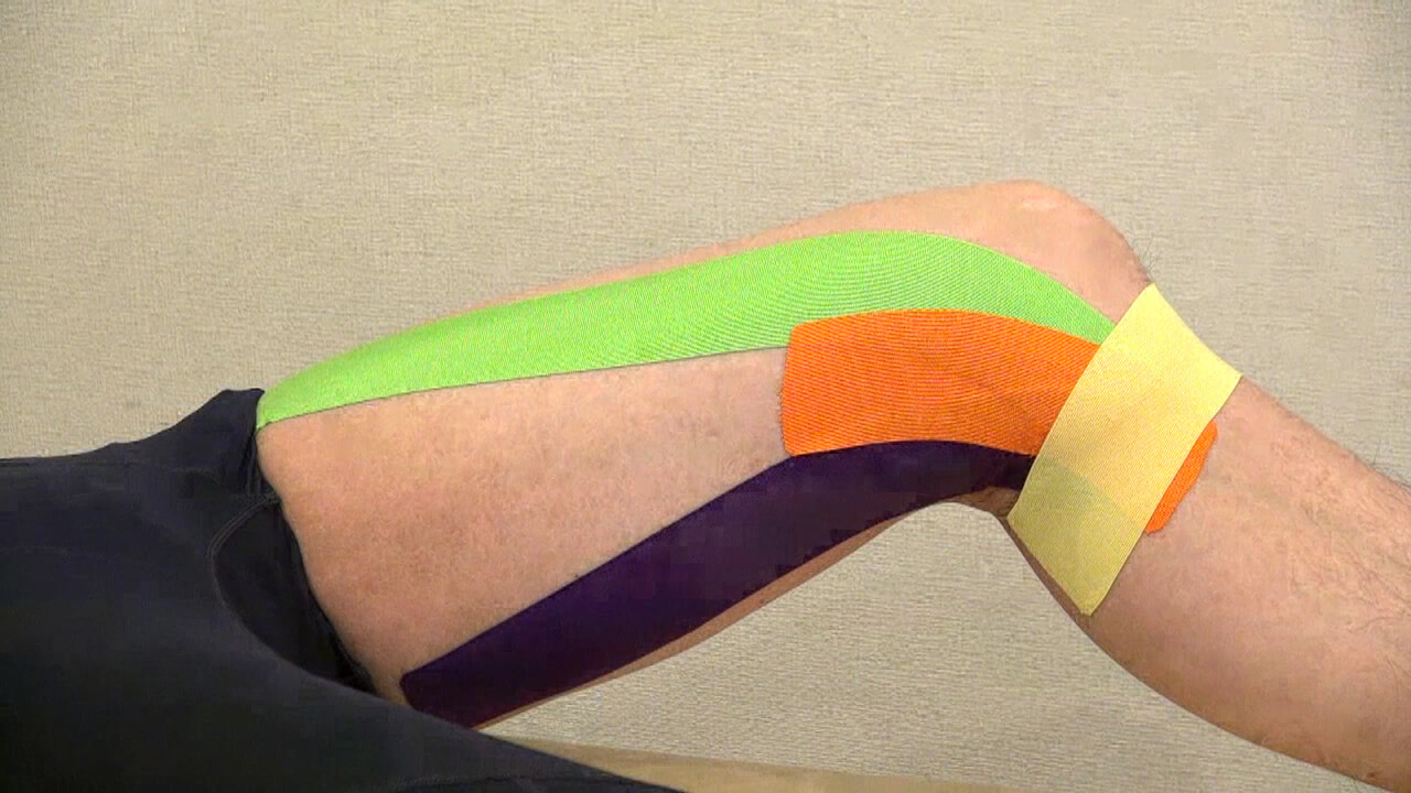 鵞足炎テーピングで膝内側の痛みが劇的に楽になる理由と正しい貼り方