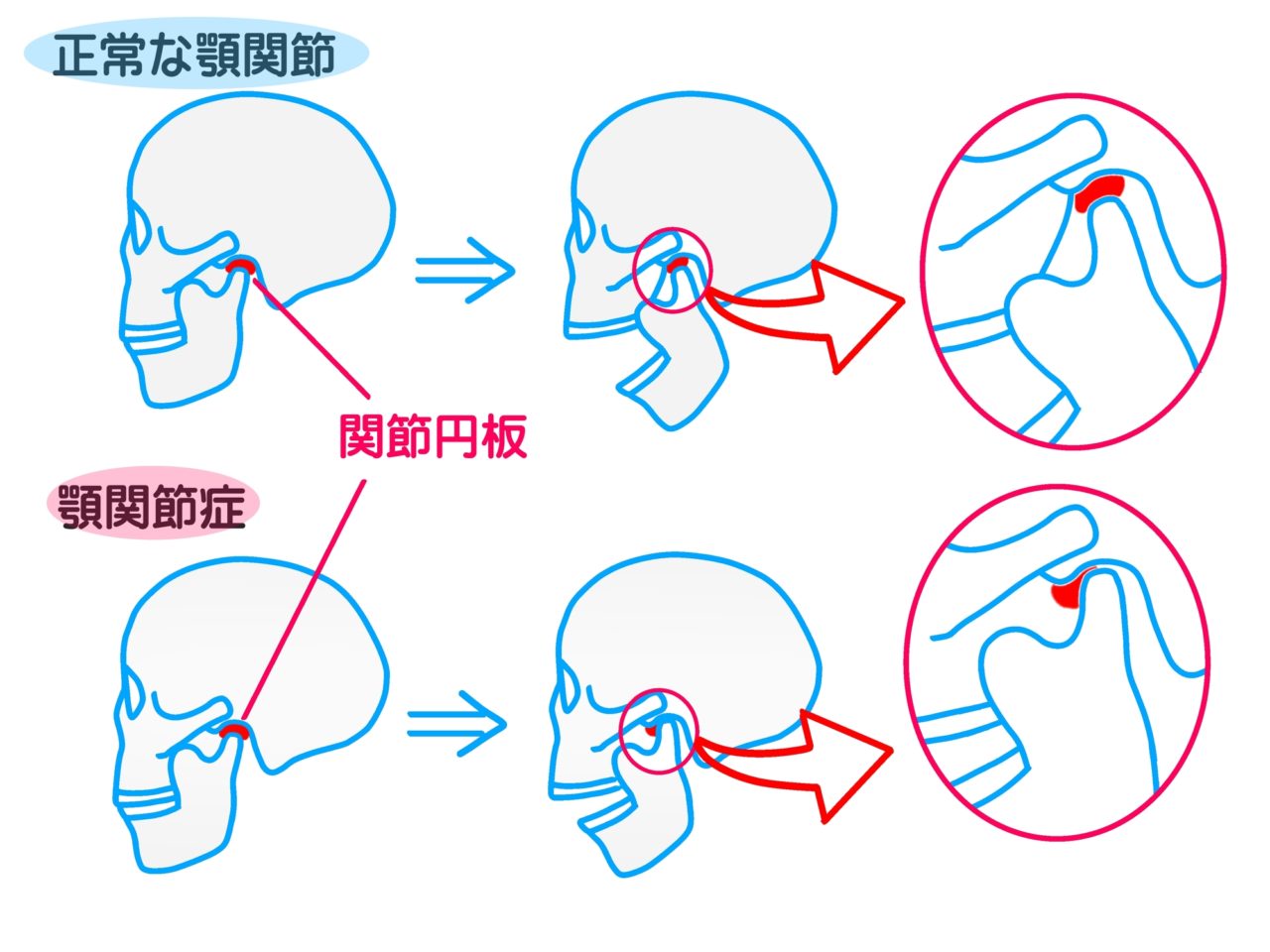 片方の顎関節が痛い原因とは？噛むと痛む病気のサインと受診の目安
