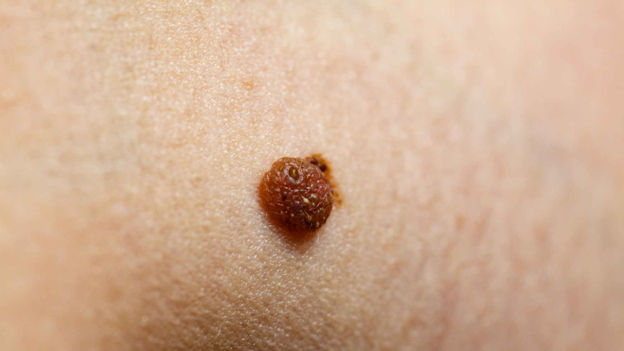 ほくろと皮膚がんの境界線｜見分け方と危険な兆候を徹底解説