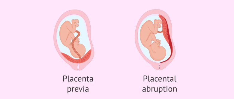 In Contrast to Abruptio Placenta Placenta Previa