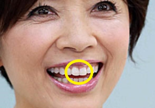 テレビでバレない秘密とは？部分入れ歯の芸能人事情と選ばれる決定的な理由