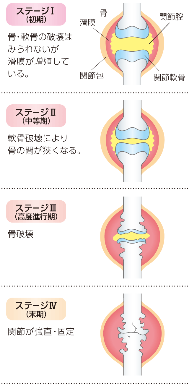関節リウマチ初期症状のサインと見分け方｜朝のこわばりや微熱の真相