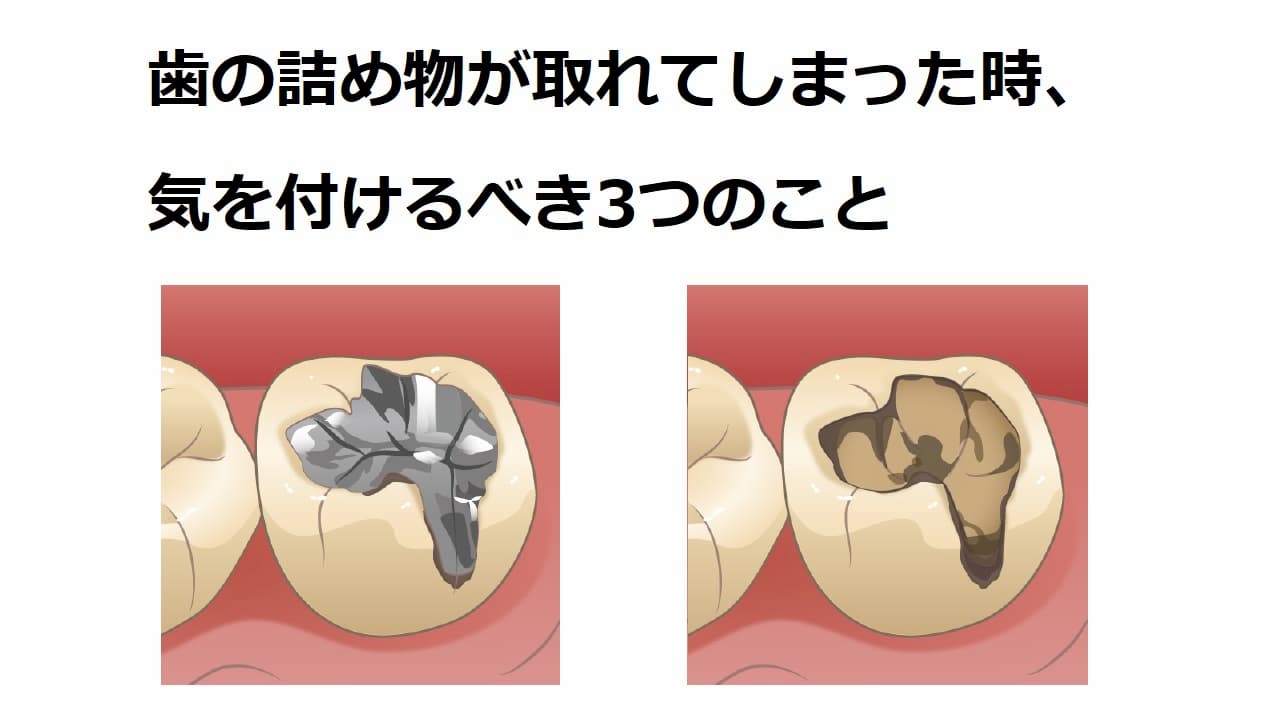 虫歯の詰め物が取れたらどうする？放置の代償と再利用・最新費用を解説