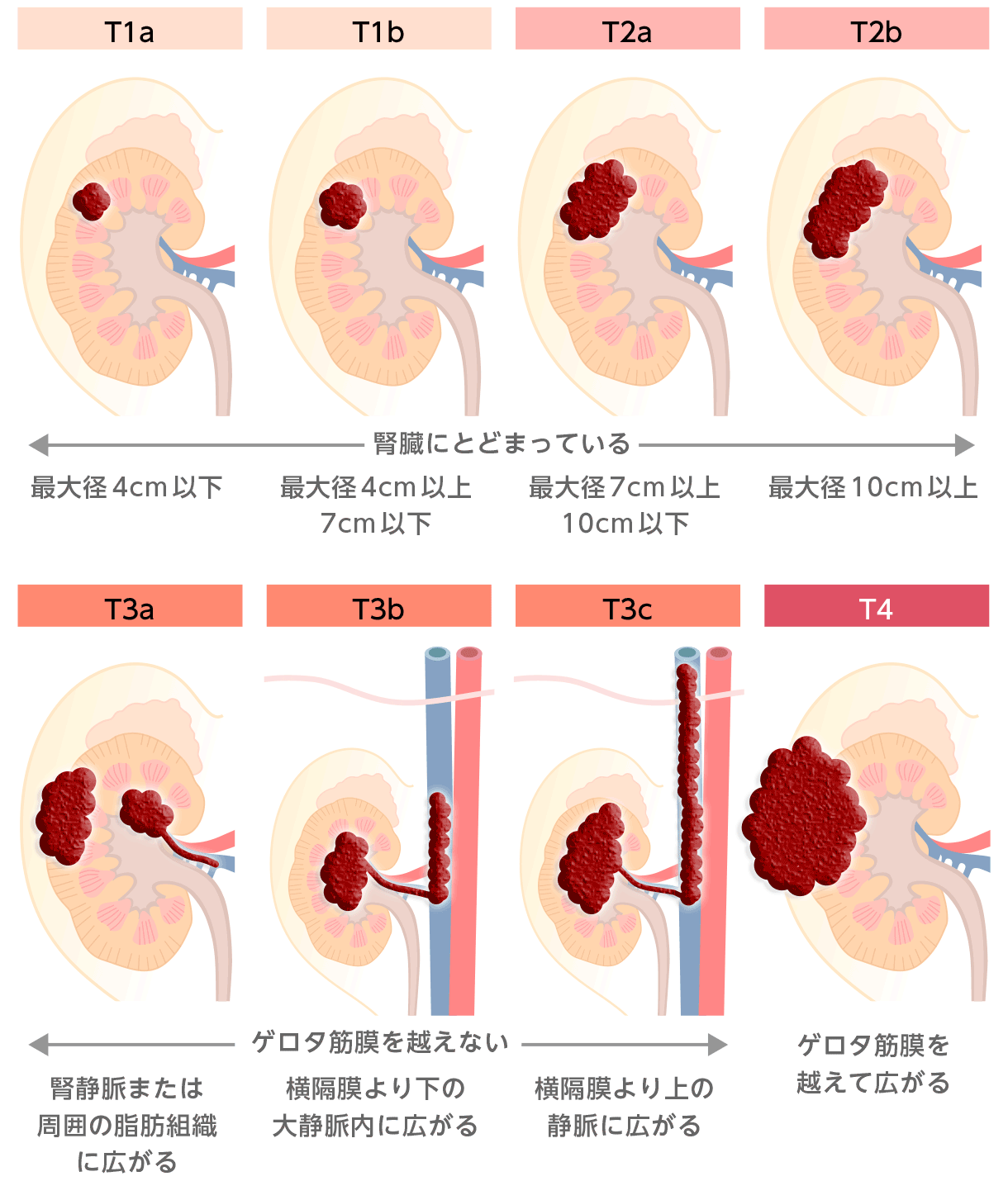 健診で腎臓に腫瘍と言われたら？悪性の確率と検査・最新治療2026