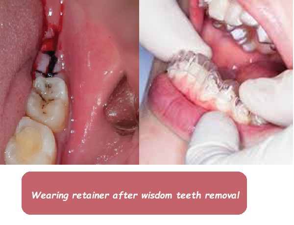 When Can You Wear Retainers After Wisdom Teeth Removal